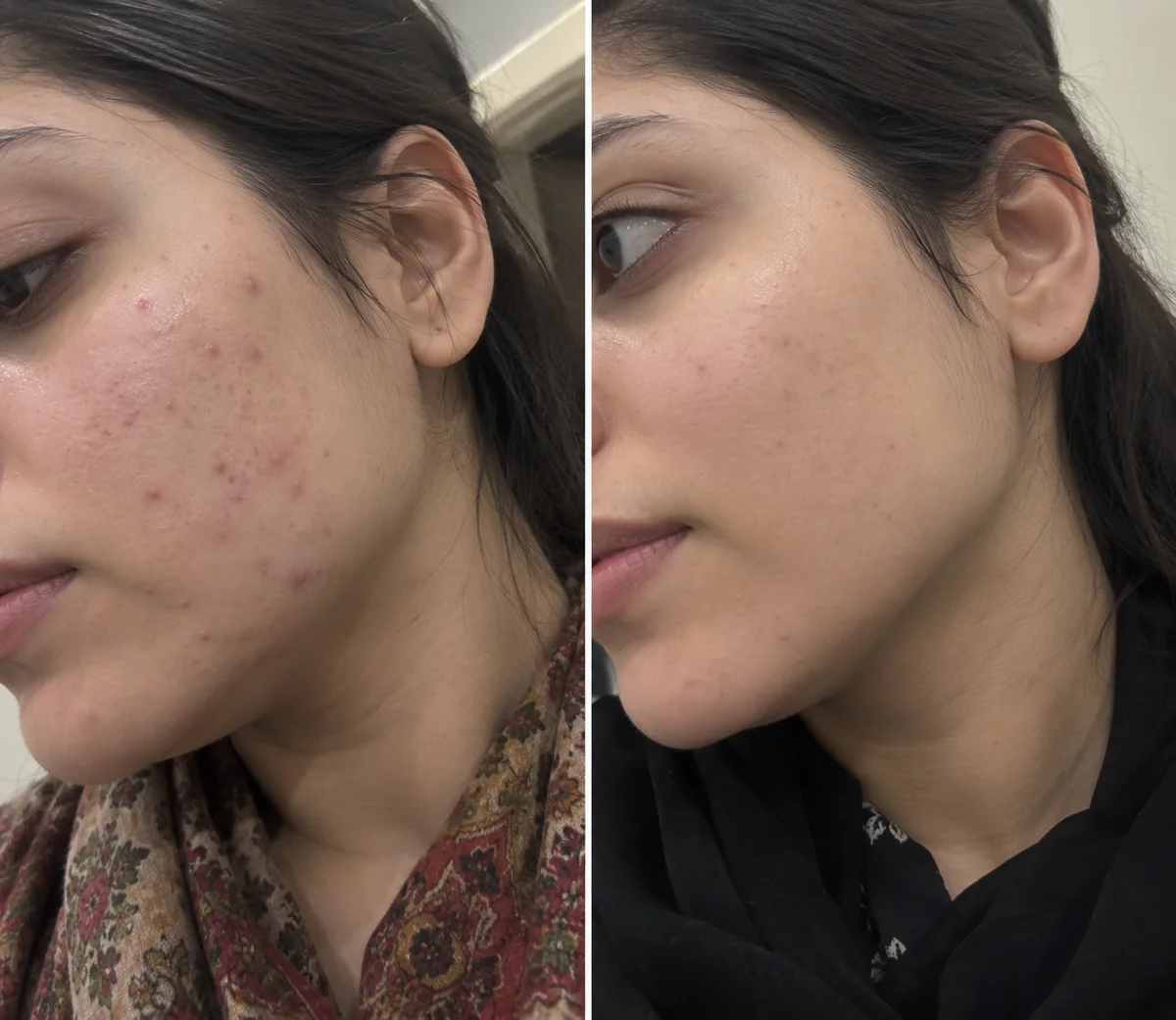 Acne Treatment before and after, Active breakouts, cleared