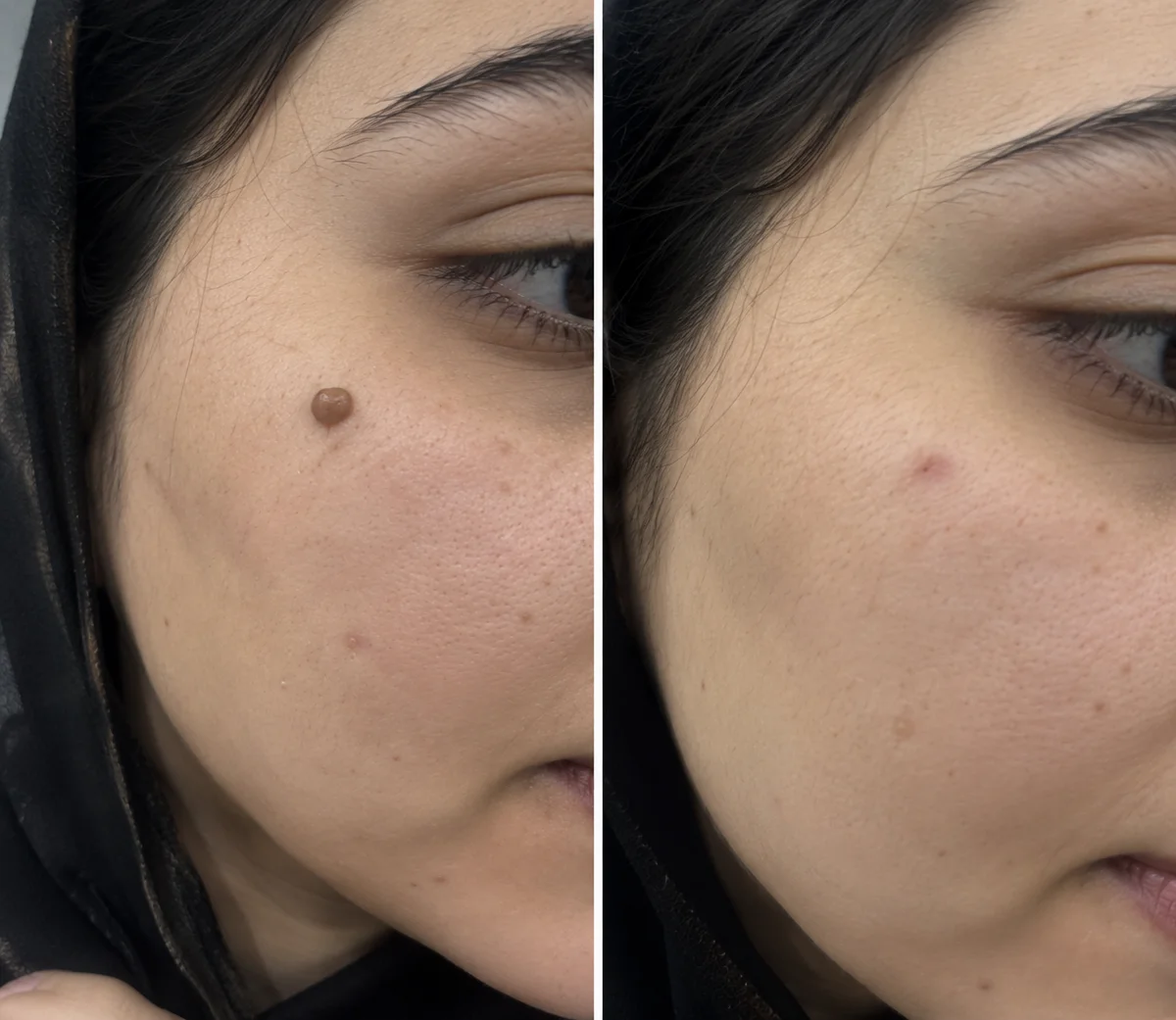 Cauterization before and after, Mole removed, minimal scarring