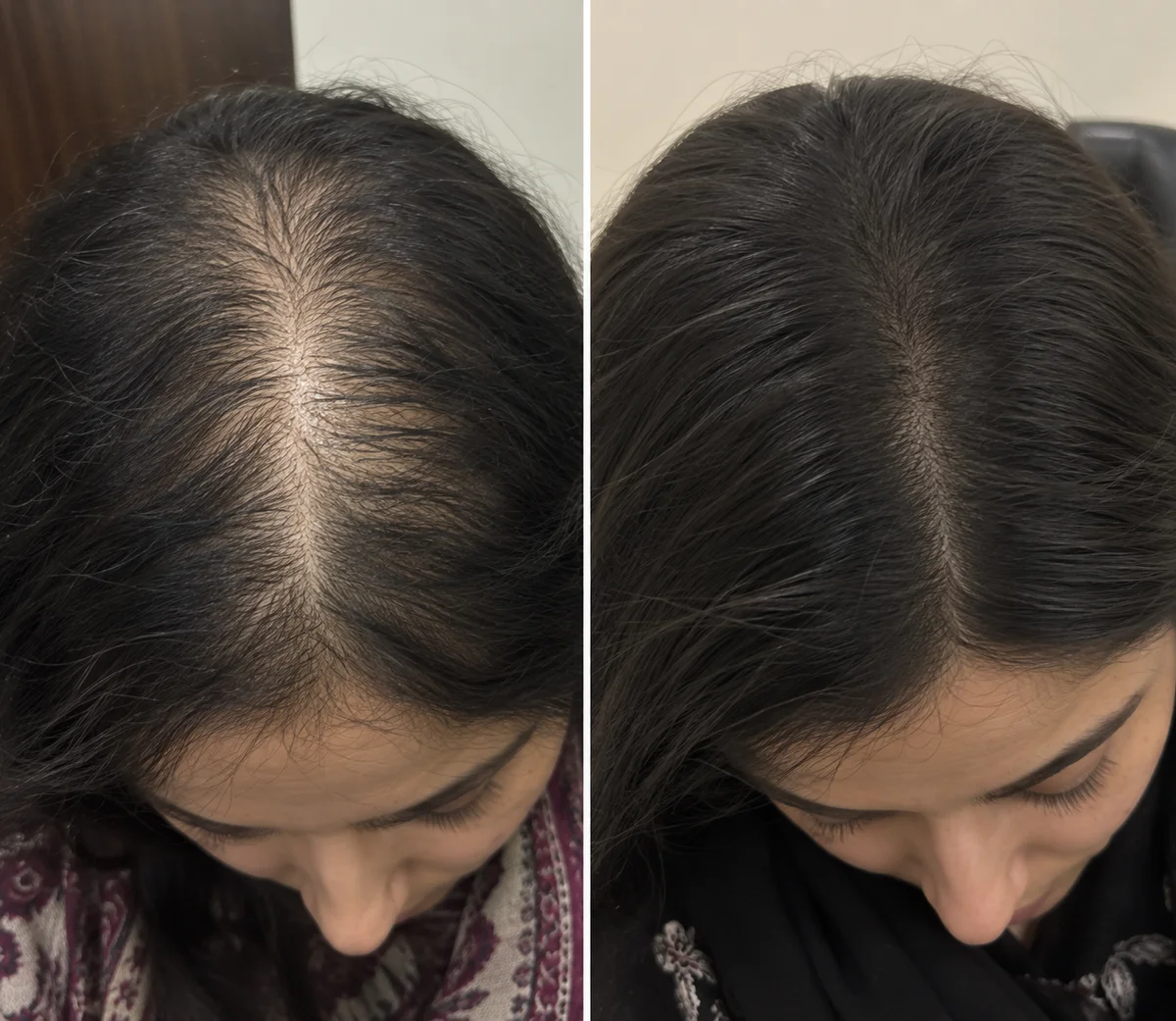 GFC Therapy before and after, Parting line & density