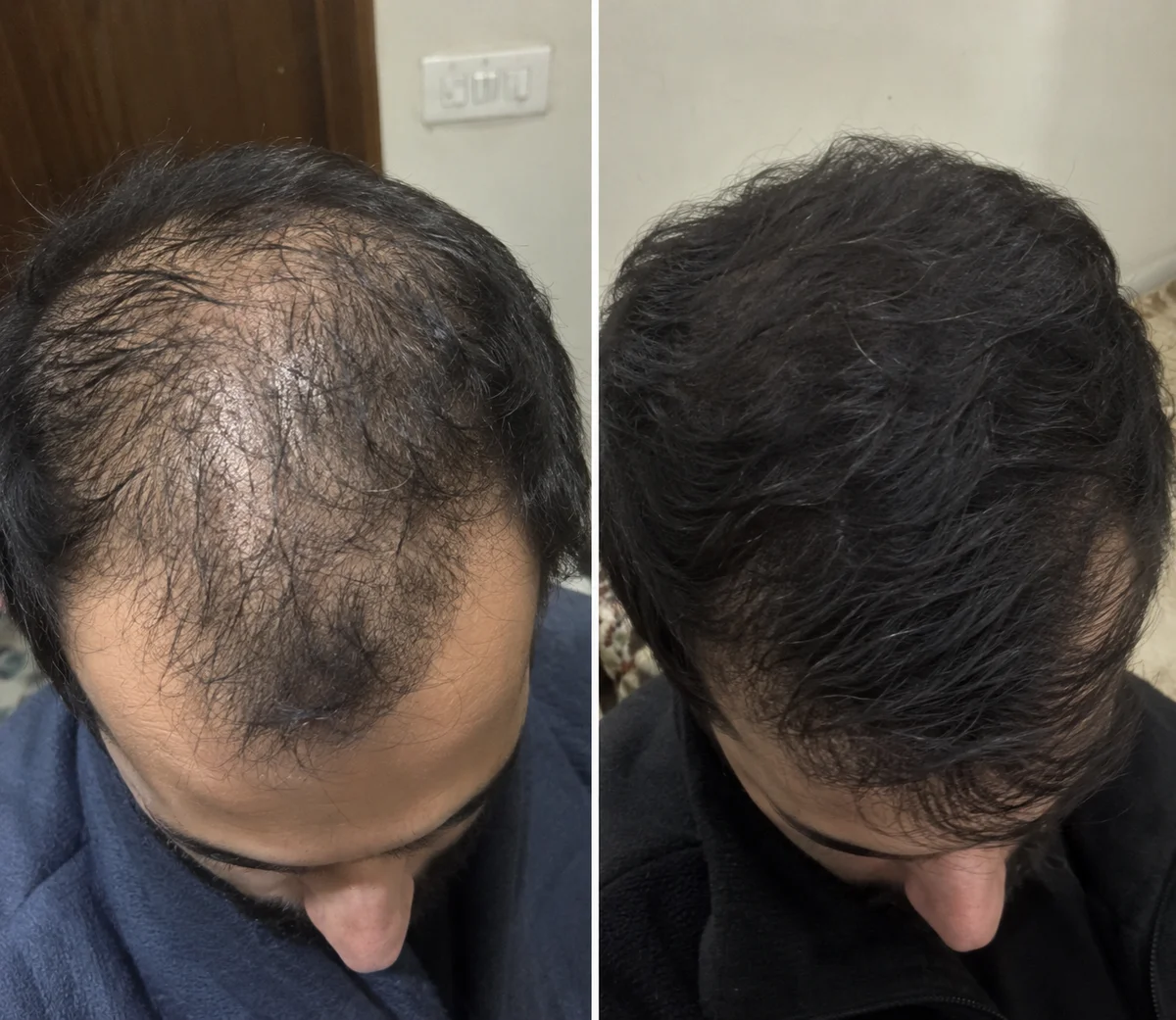 Hair Transplant before and after, Frontal hairline