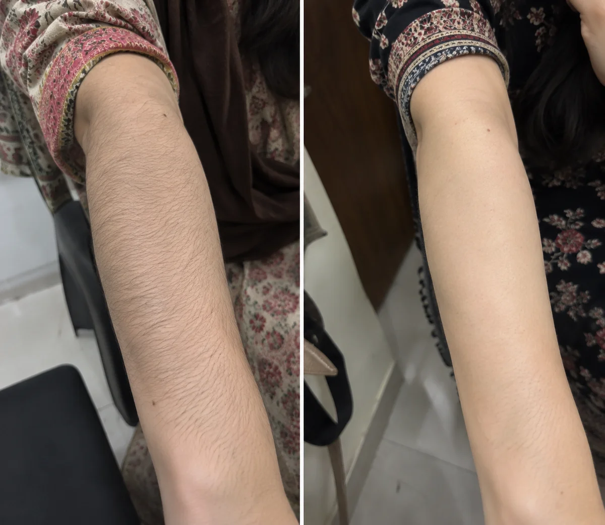 Laser Hair Reduction before and after, Smooth, hair-free skin