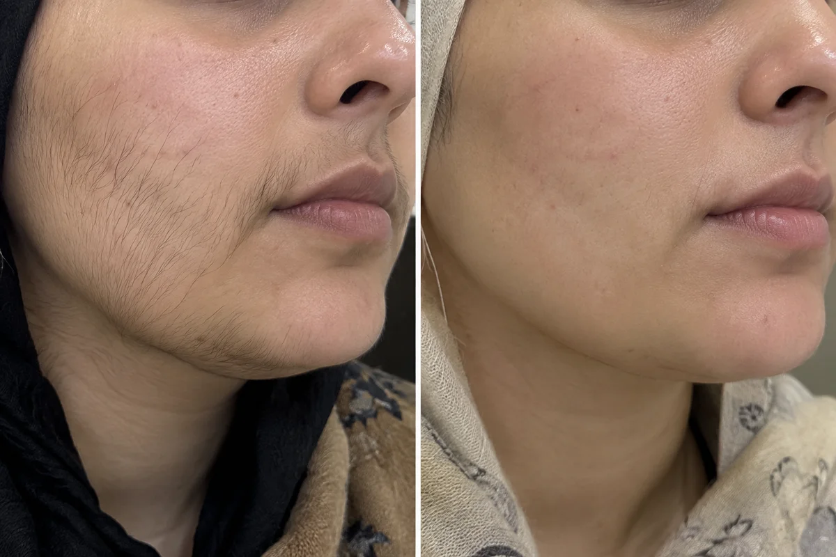 Laser Hair Reduction before and after, Facial hair, cleared